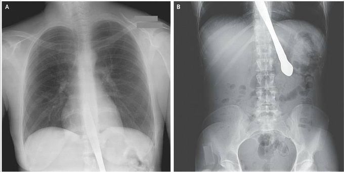 Knife stuck in esophagus and stomach