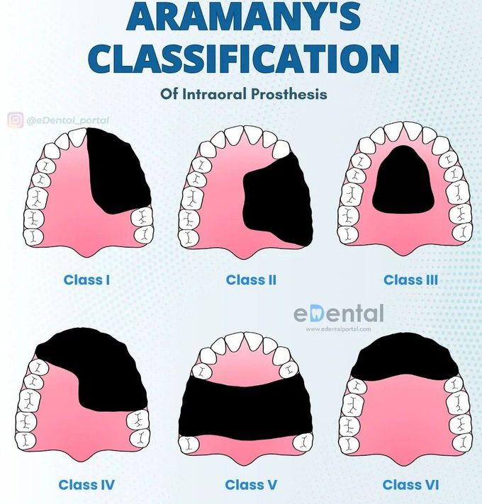 Aramany's Classification