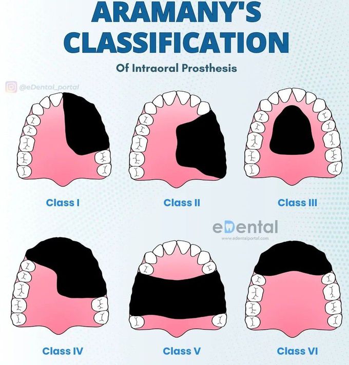 Aramany's Classification