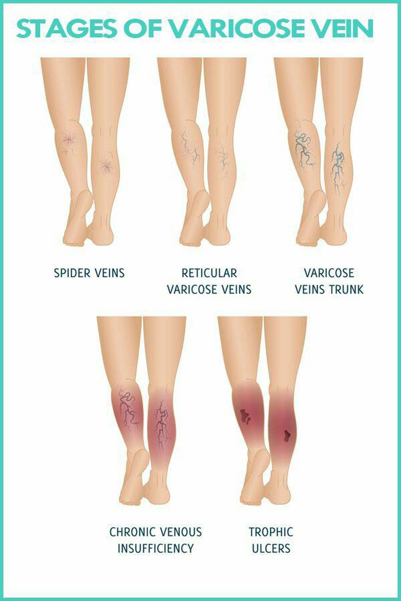 Varicose veins - MEDizzy