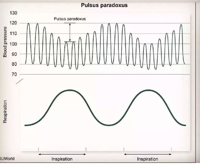 Pulsus Paradoxus