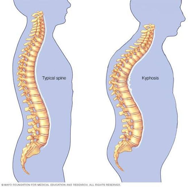 Causes of kyphosis