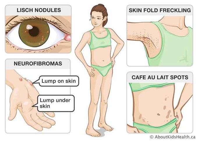 Neurofibromatosis