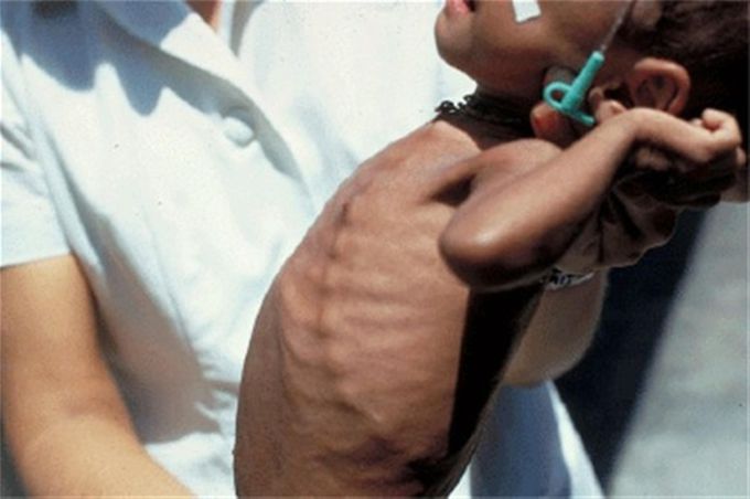 Scurvy: Cause, Signs, Symptoms, and Treatment