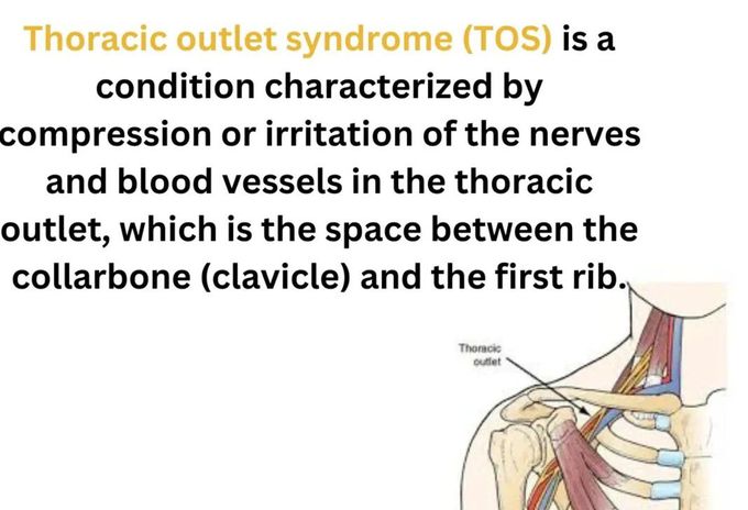 Thoracic Outlet Syndrome I