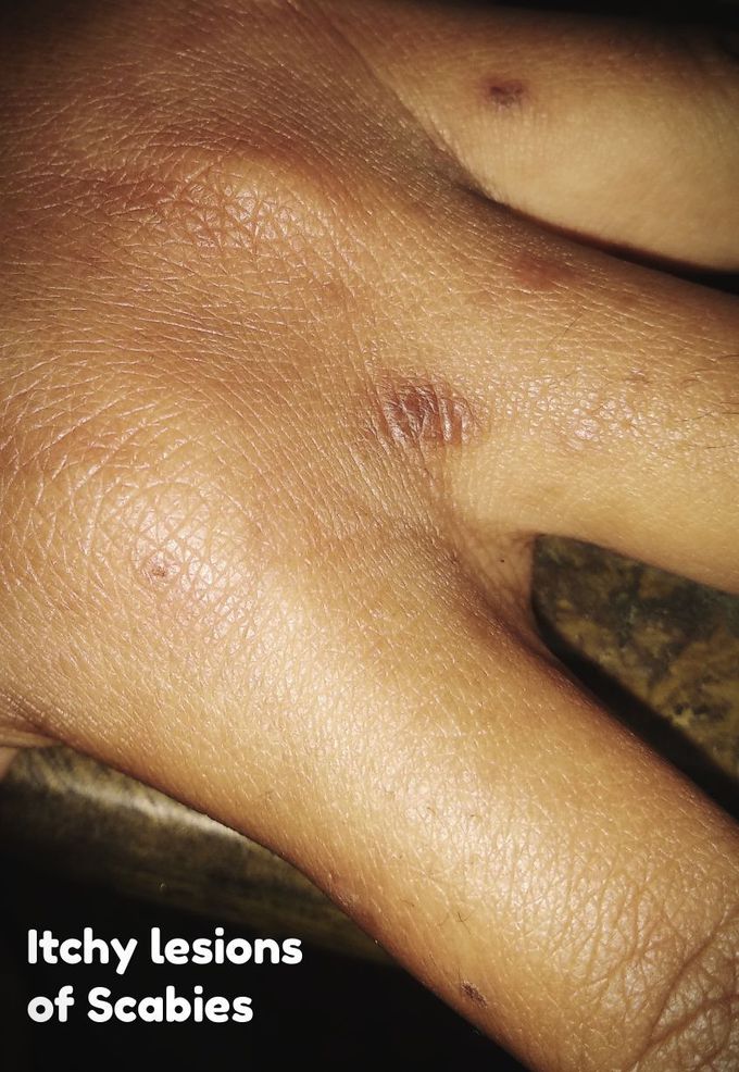 Scabies