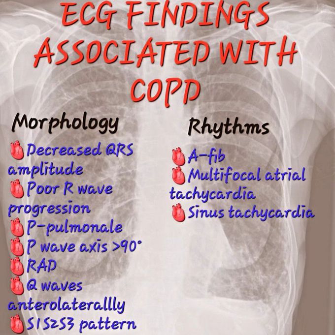 ECG Findings in COPD