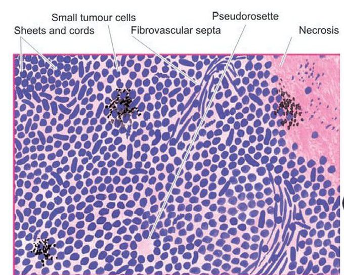 Oat cell carcinoma of the lung