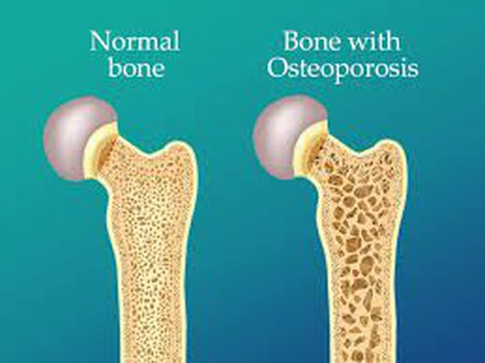 Symptoms of osteoporosis - MEDizzy