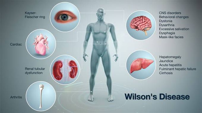 Wilson's Disease IV