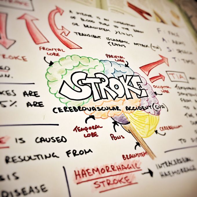 CVA/Stroke mind map