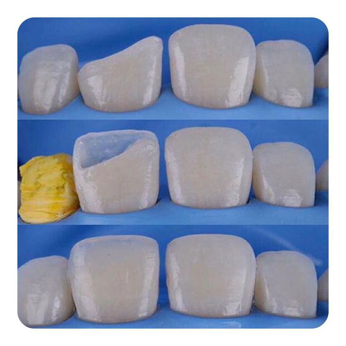 Anterior Tooth Build up