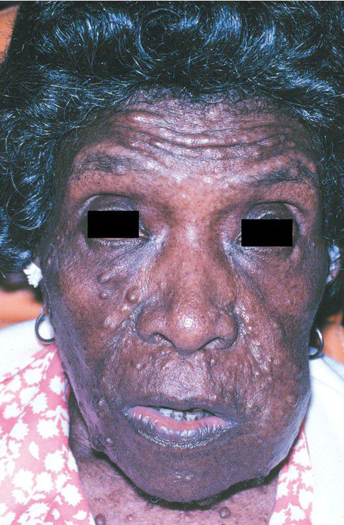 Neurofibromatosis Type I.