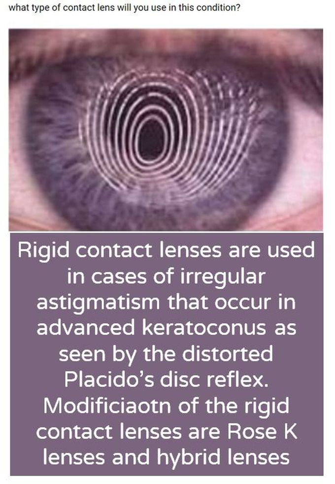 Keratoconus
