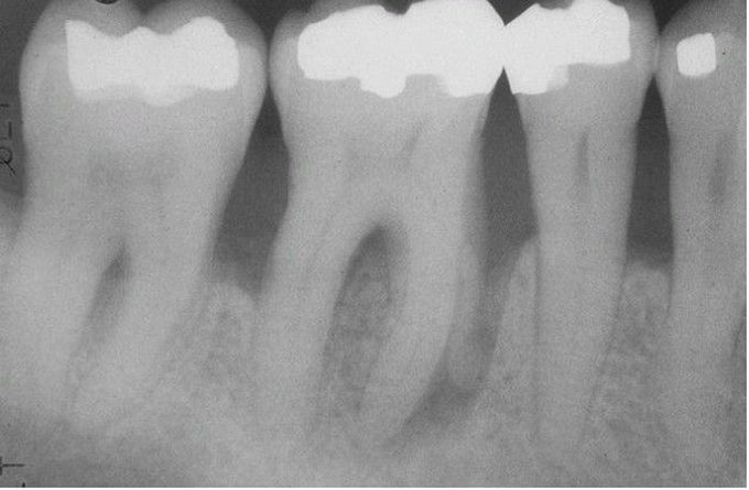 Advanced Adult Periodontitis.