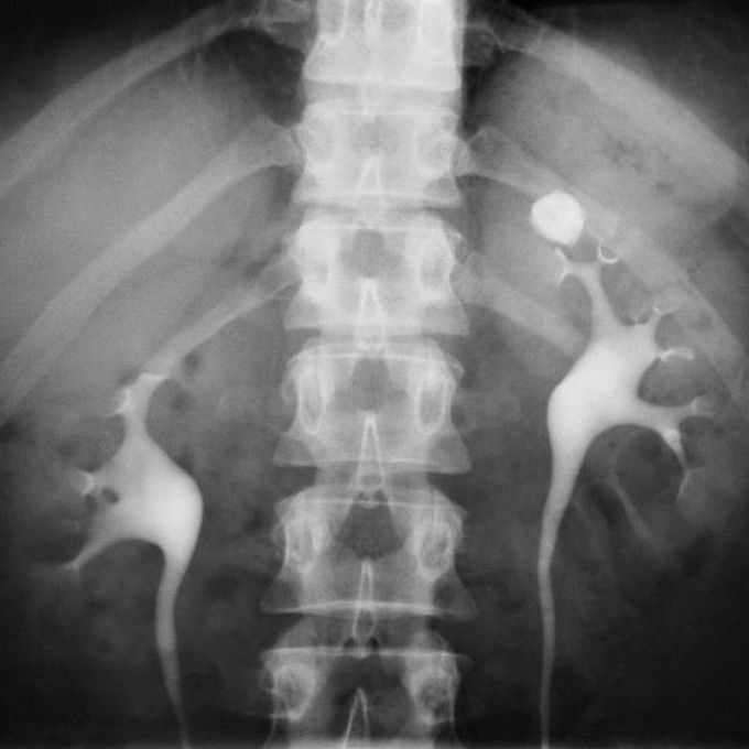 X-Ray examination showing kidney stone in the Left kidney