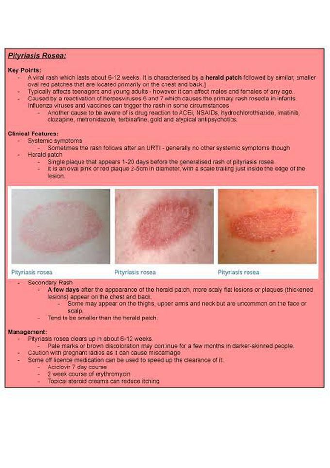 Pityriasis Rosea