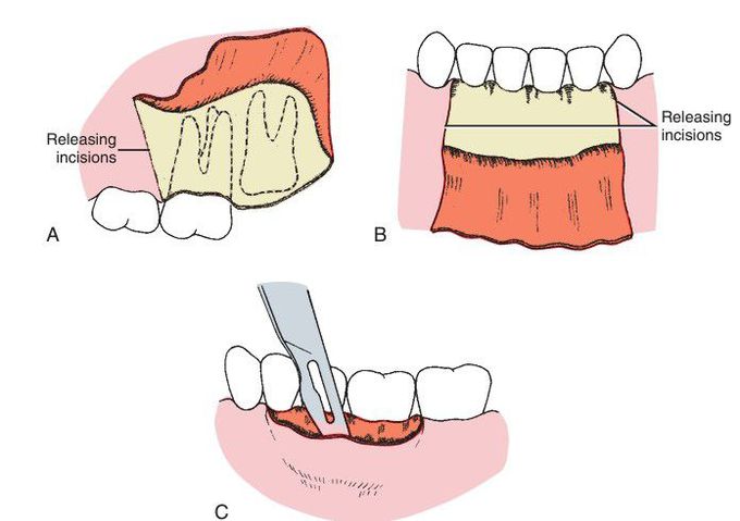 Three types of properly designed oral soft tissue flaps