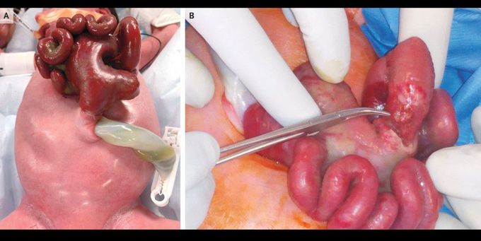 Closed Gastroschisis