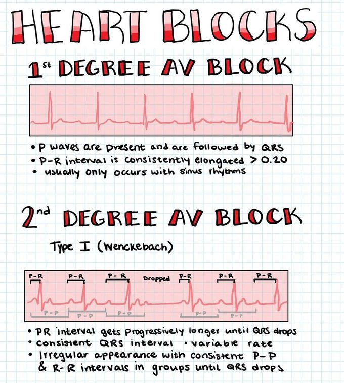 Heart Blocks I