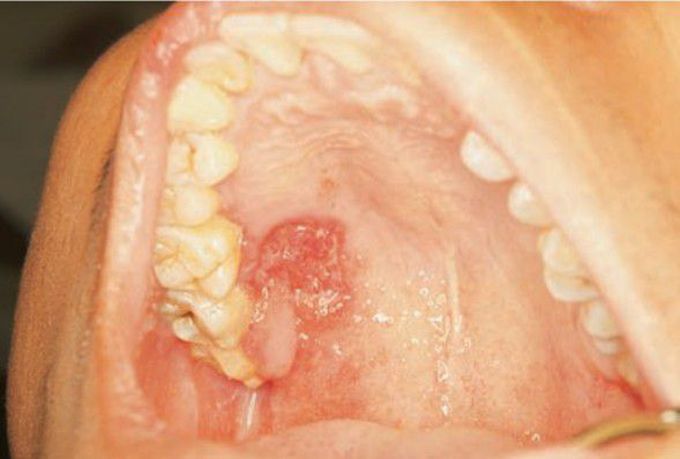 Tuberculosis of palate