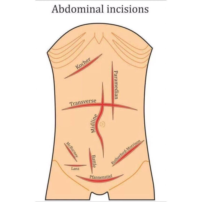 ABDOMINAL INCISIONS