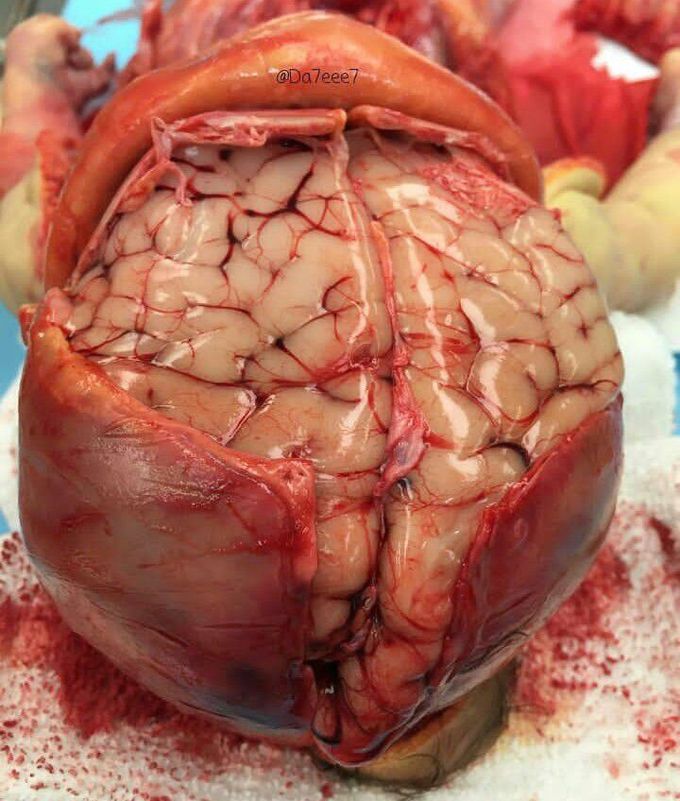 Brain from Neonate Autopsy