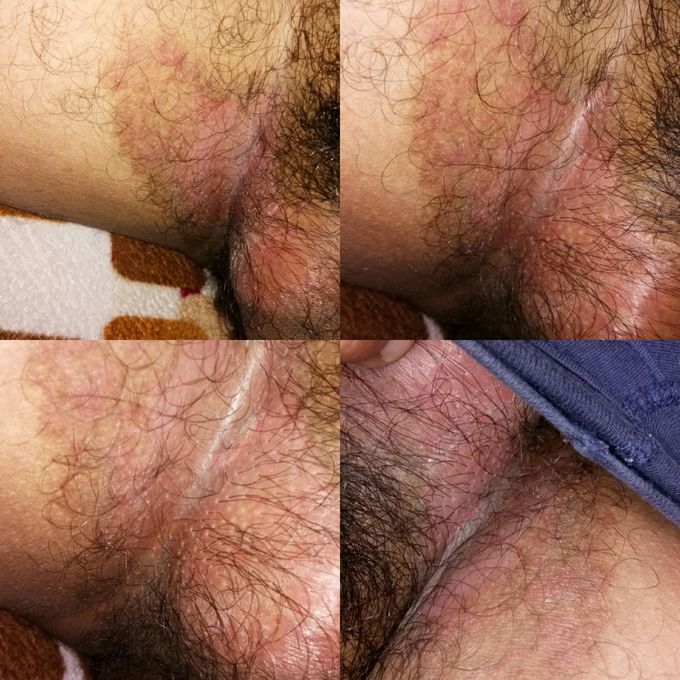 Dermatology