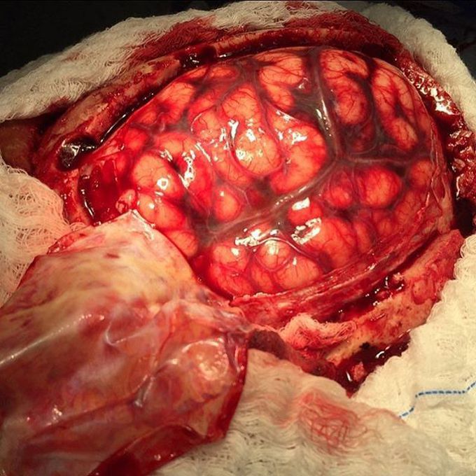 Left decompressive craniectomy in a middle aged woman that suffered from severe cerebral vasospasm resulting in MCA (middle cerebral artery) territory infarction. . 