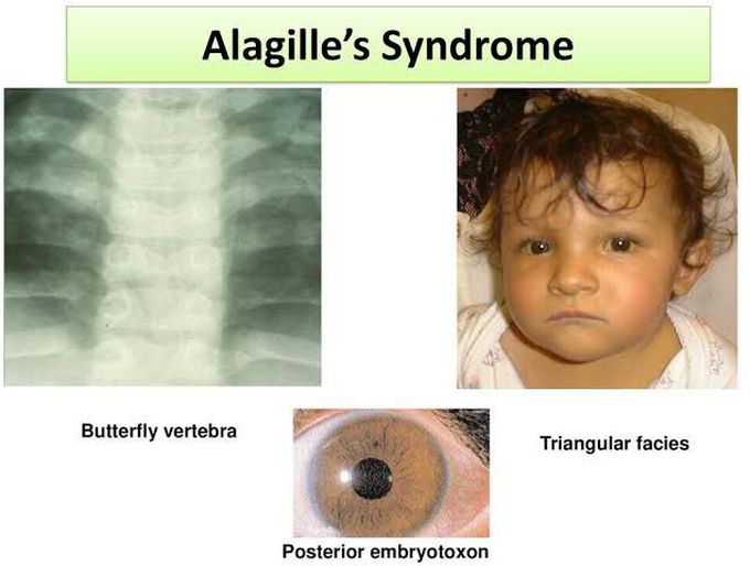 posterior embryotoxon alagille syndrome