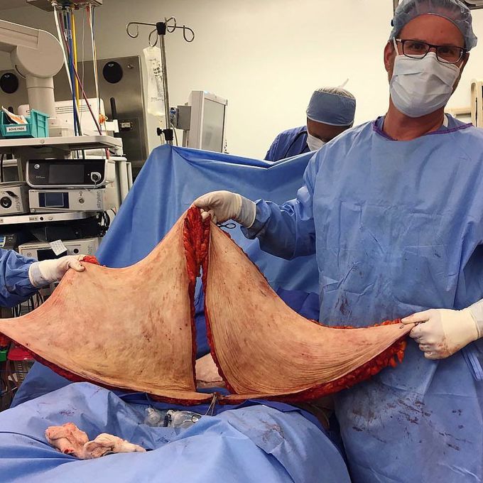 Thats a lot of excess fat and skin!! 