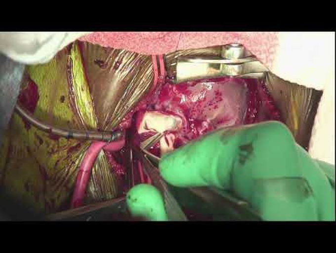 Translocation of Anomalous Origin of Right Coronary Artery from the Pulmonary Artery in an Infant