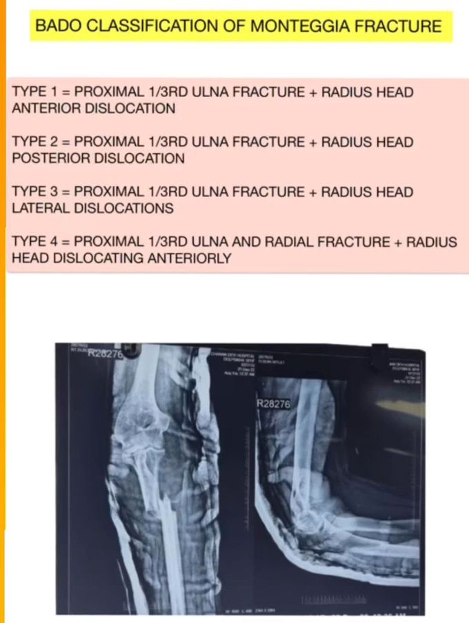 BADO CLASSIFICATION