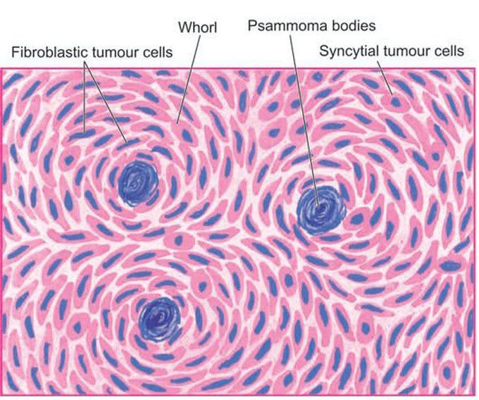 Meningioma, transitional type.