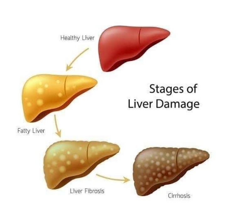 Liver damage - MEDizzy