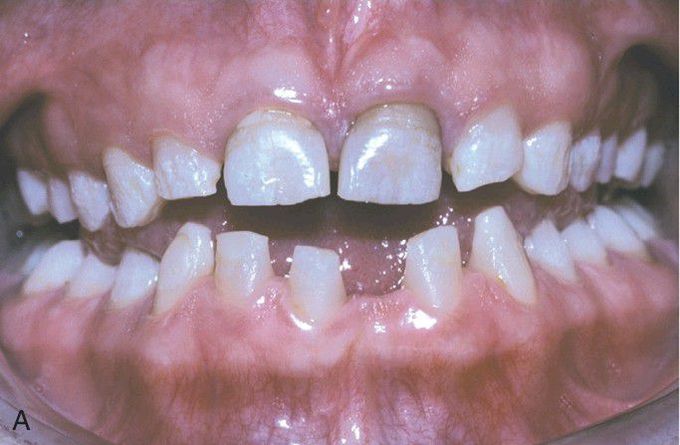 Tricho-Dento-Osseous Syndrome. 