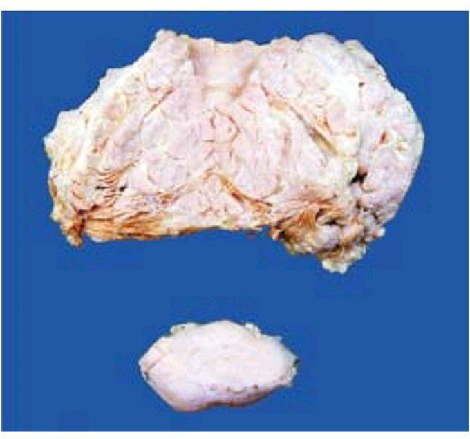 Plexiform neurofibromatosis