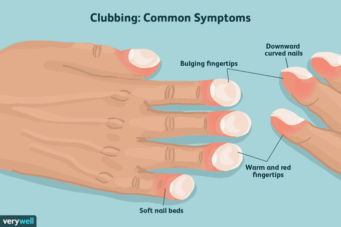 Causes and Phases of Finger Clubbing