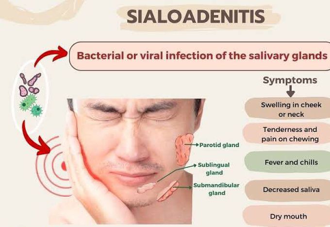 These are the symptoms of Bacterial or viral infection of the salivary glands