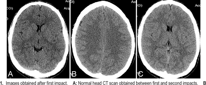 Second Impact Syndrome