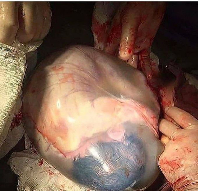 A wonderful shot of 'en caul' baby
