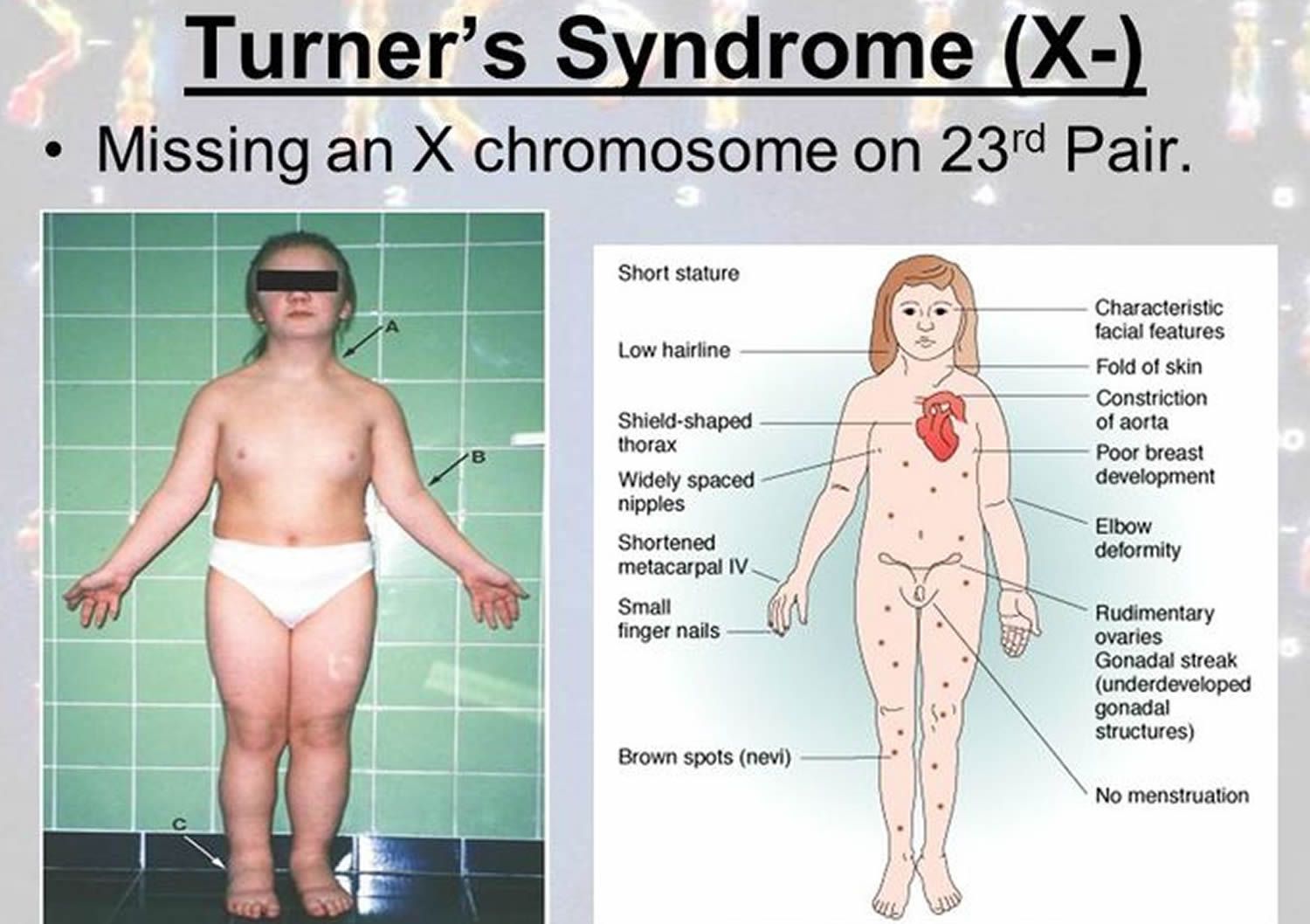 Turner Syndrome Medizzy