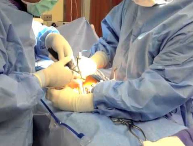 Intraoperative navigation assisted placement of percutaneous pedicle screws