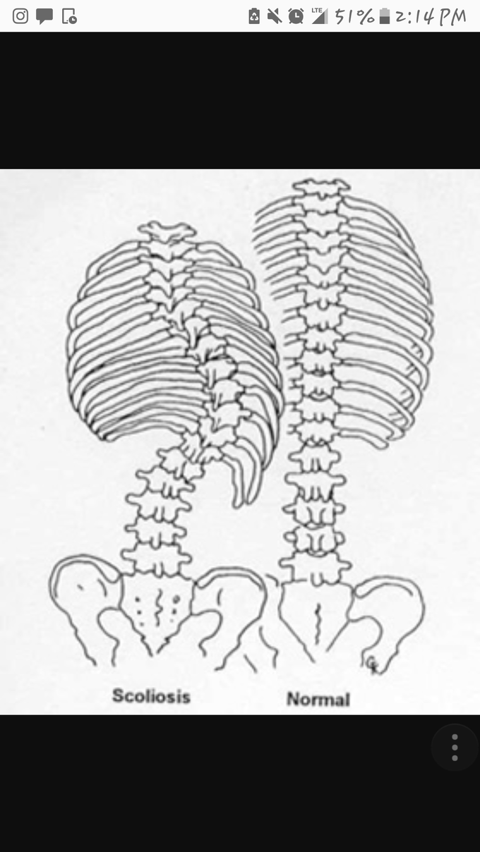I have scoliosis that twists one way then another