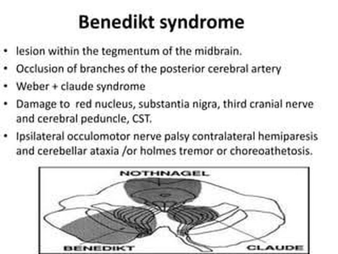 paramedian midbrain syndrome