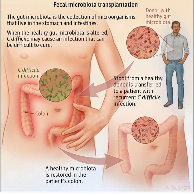 Fecal microbiota transplantation