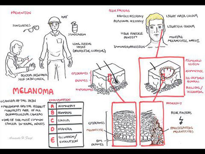 Pathology of skin epidermis (MELANOMA)