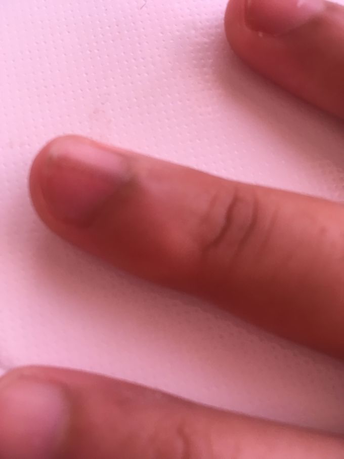 Why has her nail changed shape?