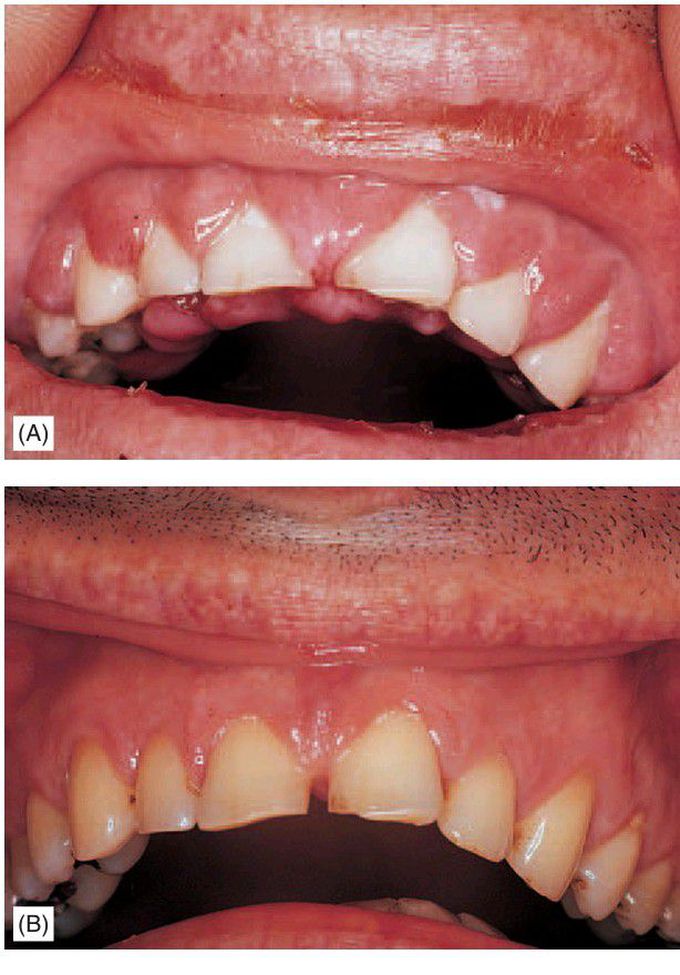 Acute leukaemia