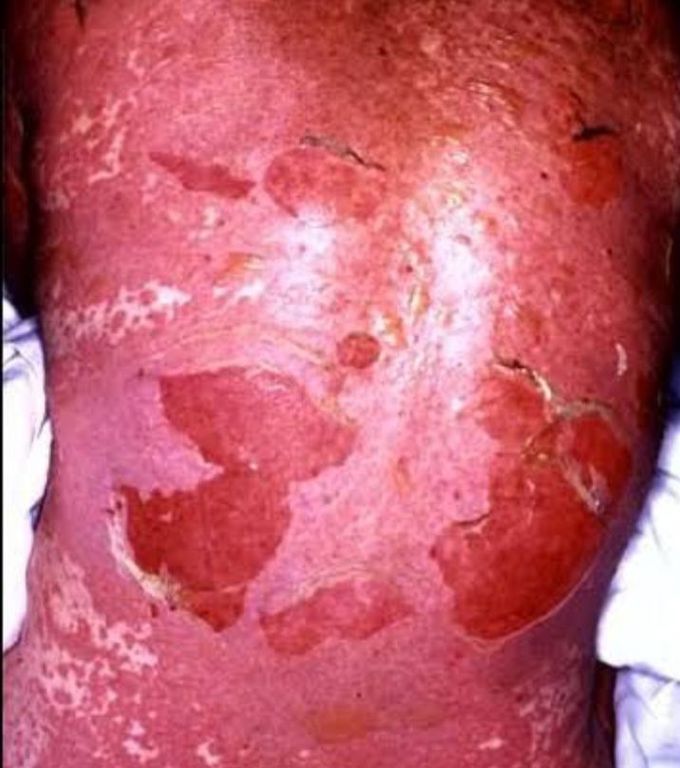 Toxic Epidermal Necrolysis